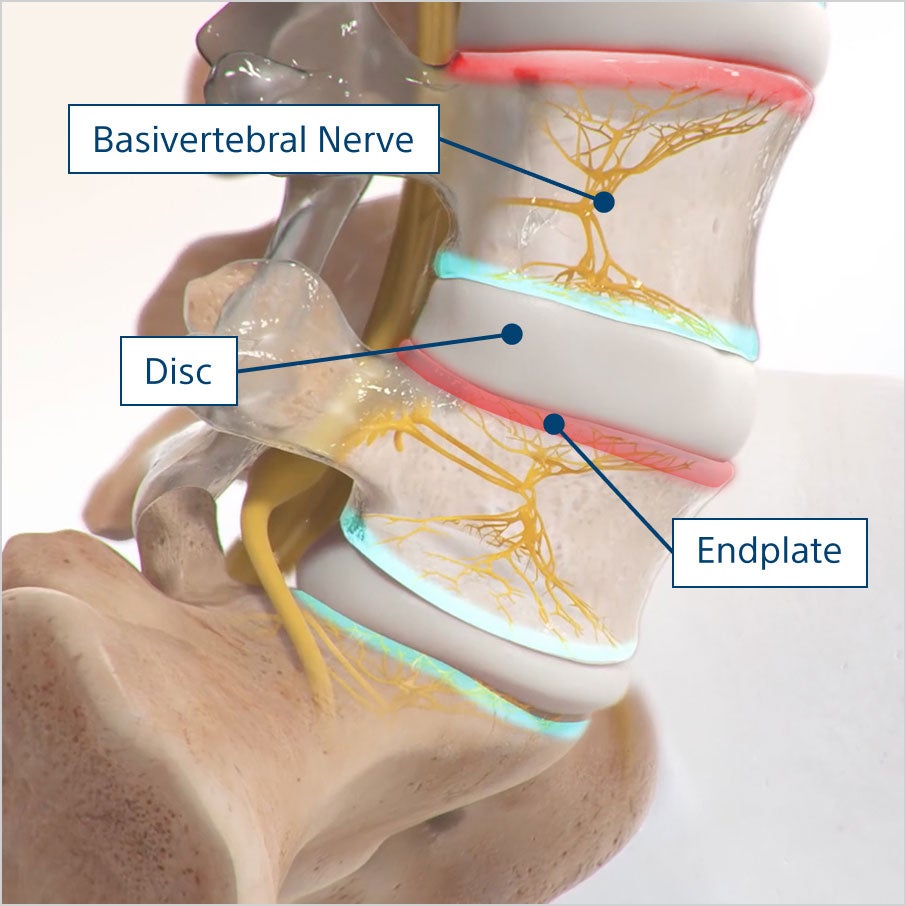 Detailed view of spinal anatomy showing the basivertebral nerve, disc, and endplate. 