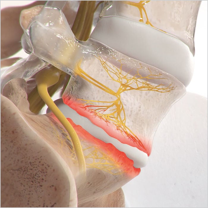 A close-up of a spinal section showing nerves, disc, and highlighted inflammation. 