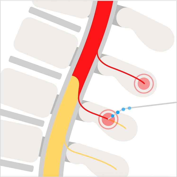 A diagram of a spine showing a highlighted area in red, and a probe going into a nerve.