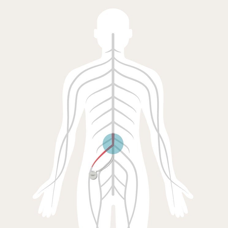 Illustration of a human body with highlighted nerve pathways and the SCS device near the lower back. 