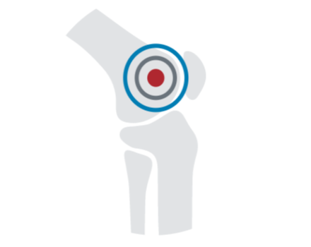 Diagram highlighting Radiofrequency Ablation on a knee joint.