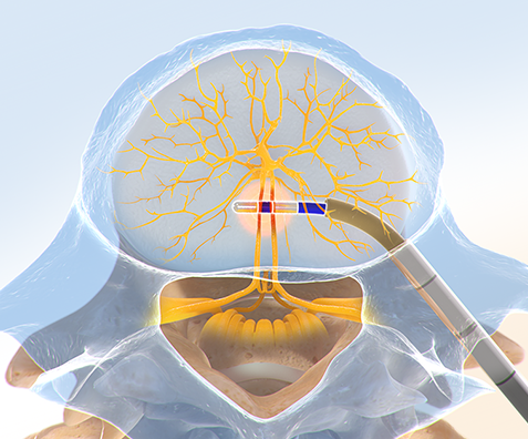 Front views of the WaveWriter Alpha Spinal Cord Stimulation System.
