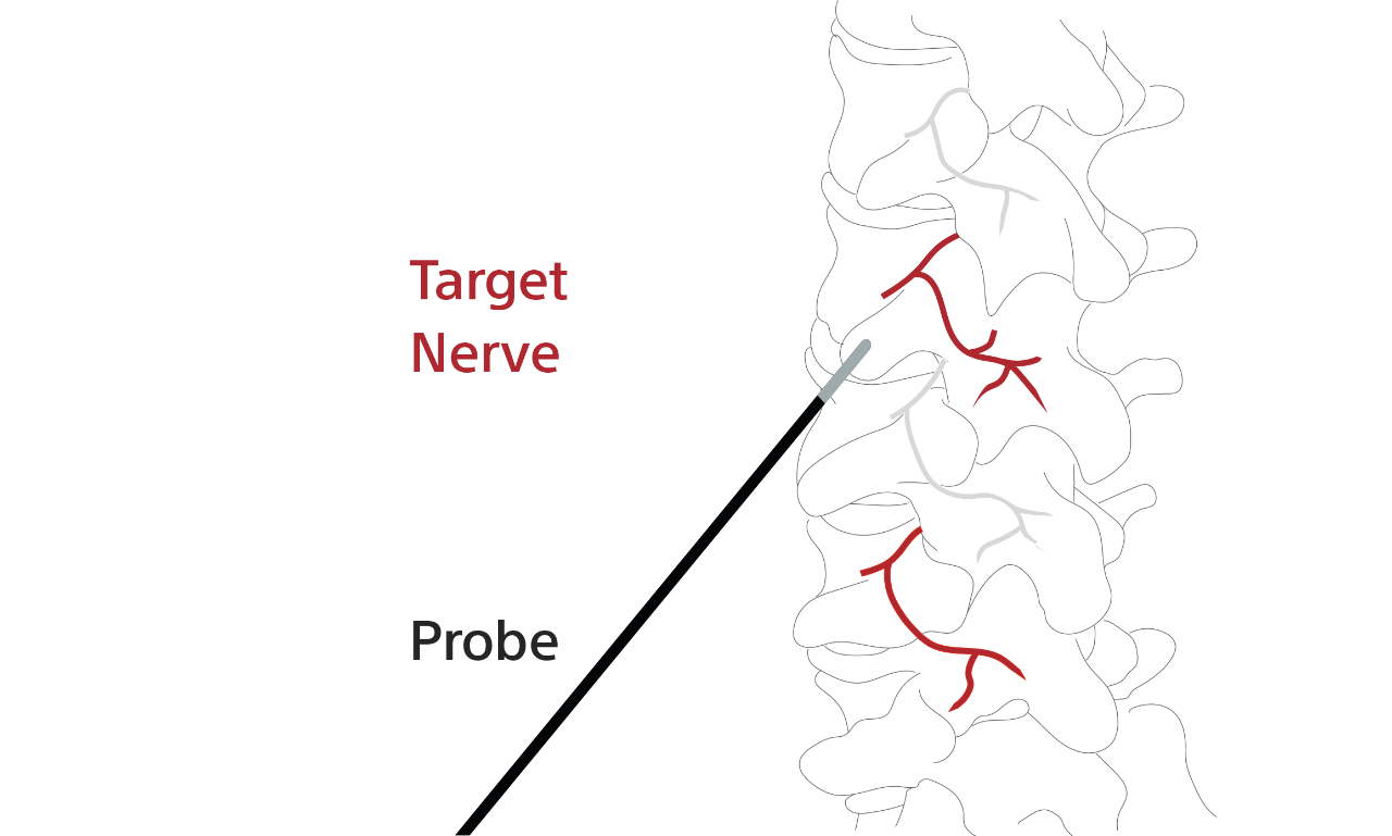 Diagram of the spine showing how a probe is inserted to stimulate a target nerve.