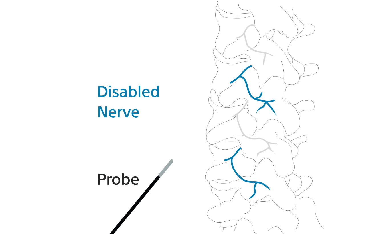 Diagram of the spine showing multiple disabled nerves after the probe has been removed.