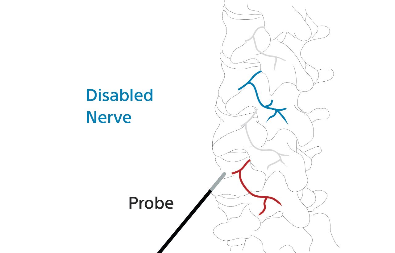 Diagram of the spine showing a disabled nerve after being probed.