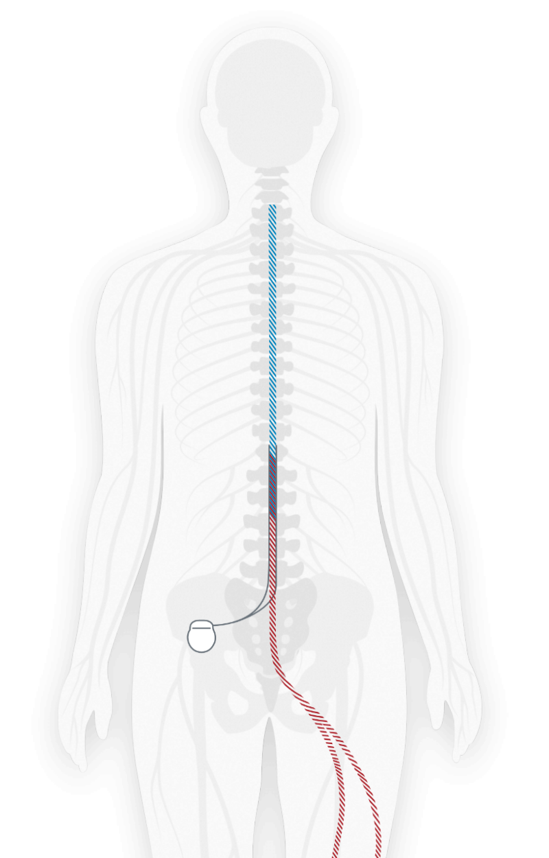 Physical Therapy in our clinic for Pain Care Spinal Cord Stimulators