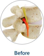 Diagram of the spine before the Vertiflex procedure.