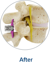 Diagram of the spine after the Vertiflex procedure.