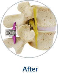 After. Vertebral region with placement of spacer. Nerves no longer pinched.