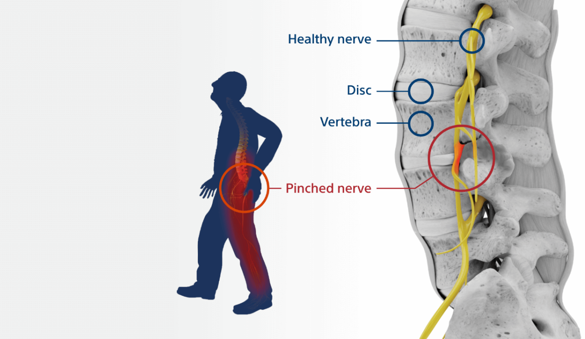 New type of nerve stimulation relieves chronic back pain