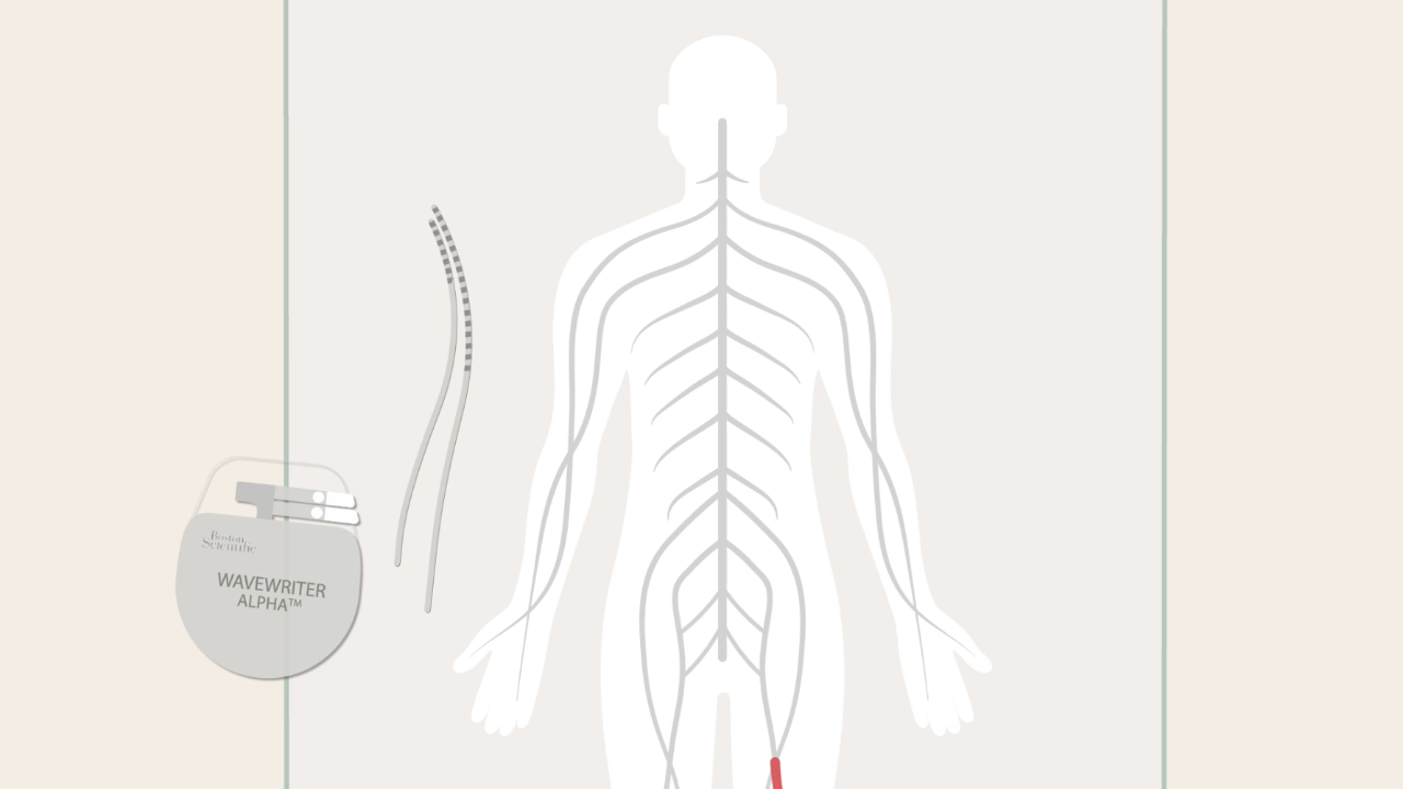 Illustration of human body, Wavewriter Alpha IPG and leads.