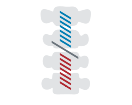 Diagram representing Spinal Cord Stimulation.