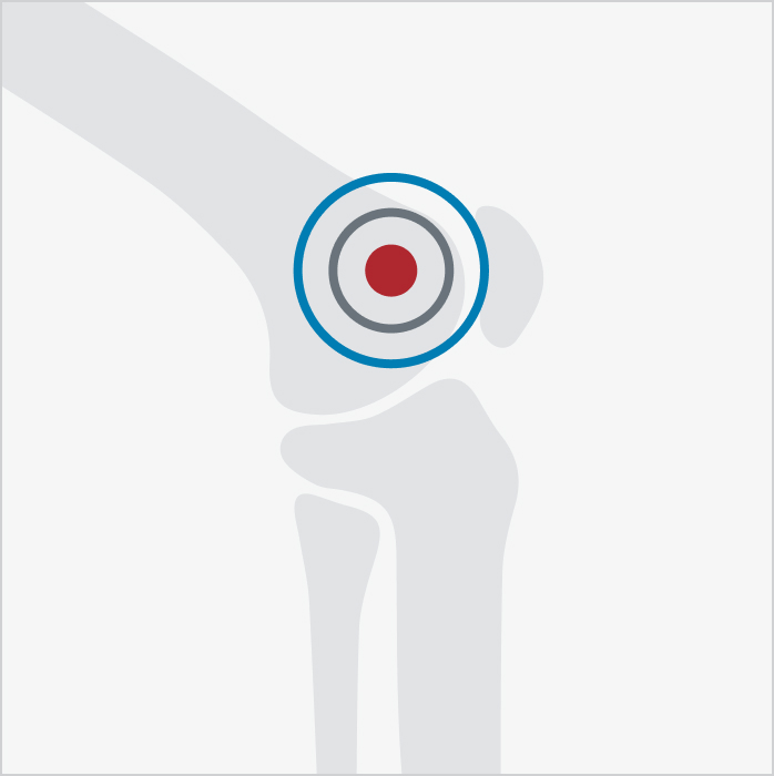 Diagram highlighting Radiofrequency Ablation on a knee joint.