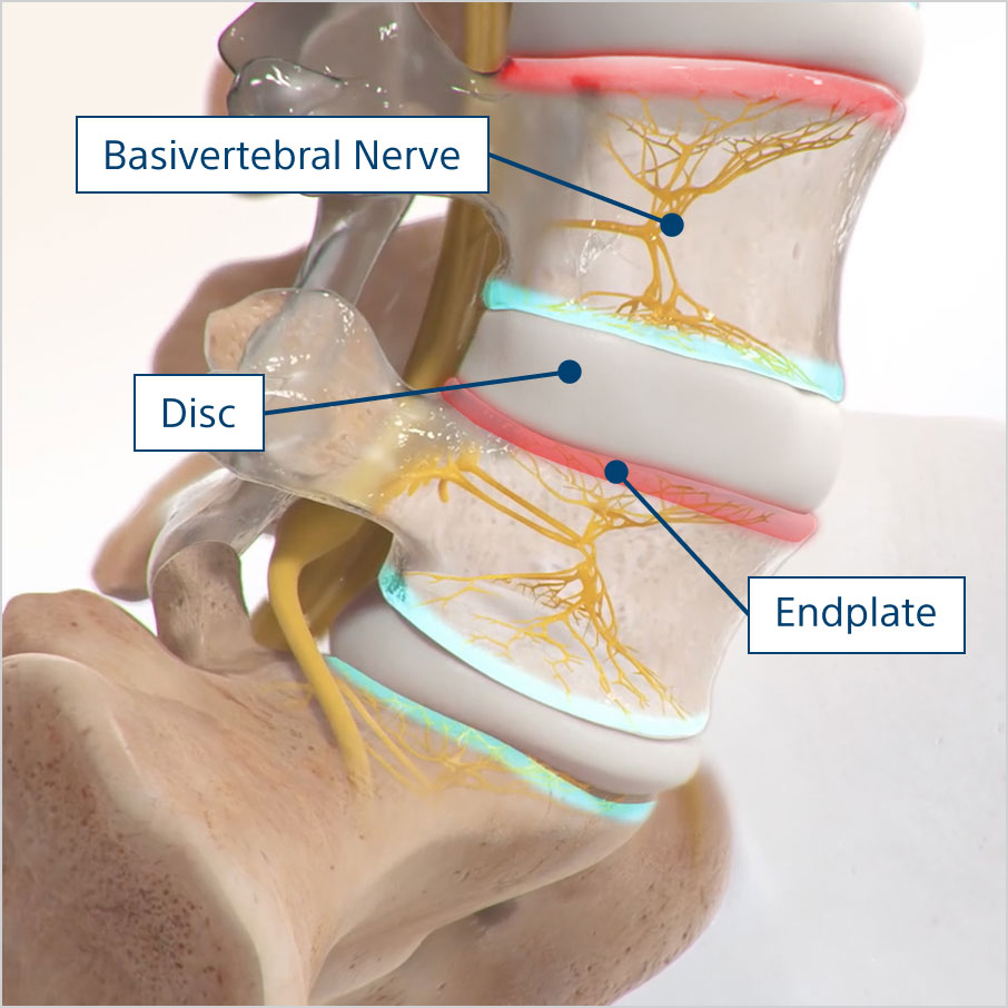 Detailed view of spinal anatomy showing the basivertebral nerve, disc, and endplate. 