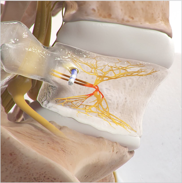Detailed view of a spinal disc with a tool heating up the impacted nerve root. 