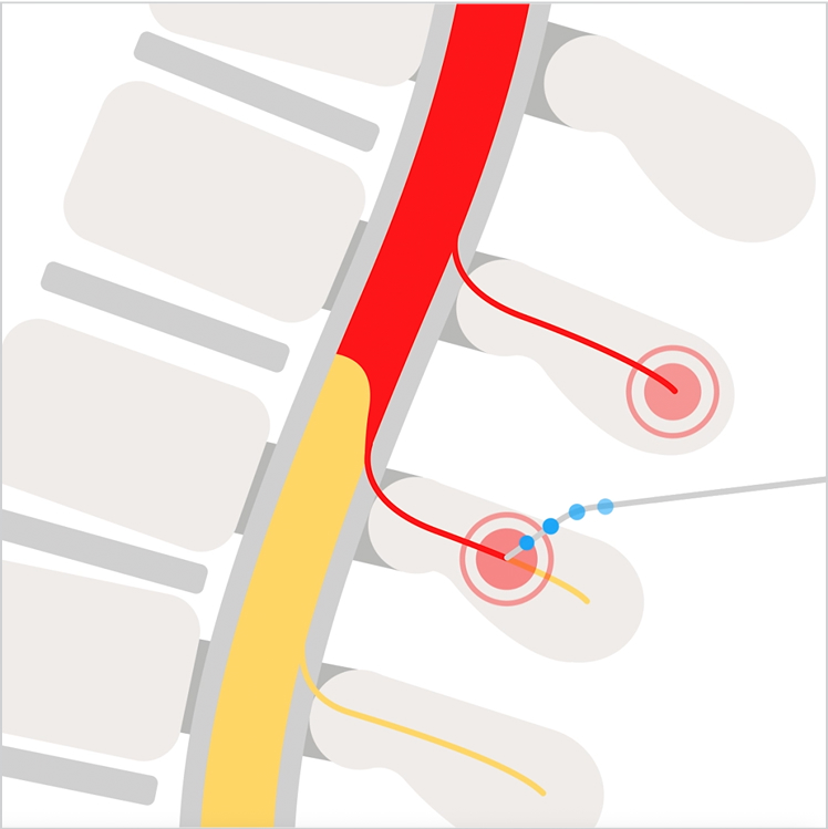 A diagram of a spine showing a highlighted area in red, and a probe going into a nerve.